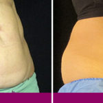 before-after-coolsculpting-3