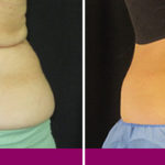 before-after-coolsculpting-3a