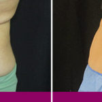 before-after-coolsculpting-3b