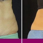 before-after-coolsculpting-3c