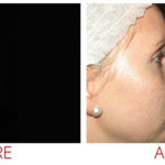 collagen-pin-before-after-01