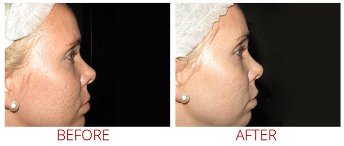 collagen-pin-before-after-01