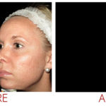 collagen-pin-before-after-03