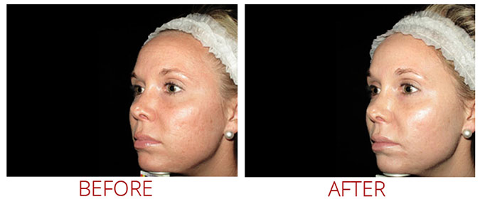 collagen-pin-before-after-03
