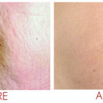 collagen-pin-before-after-04