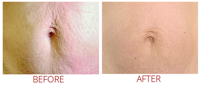collagen-pin-before-after-04