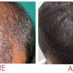 collagen-pin-before-after-05
