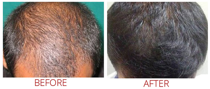 collagen-pin-before-after-05