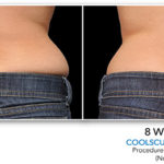 coolsculpting-treatment-before-after-1