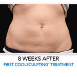 coolsculpting-treatment-before-after-2