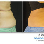 coolsculpting-treatment-before-after-4c