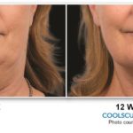 coolsculpting-treatment-before-after-chin1
