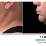 coolsculpting-treatment-before-after-chin2