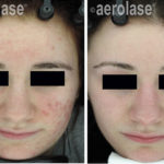 NeoClear Acne – 3 Months After 5 Treatments – David Goldberg MD