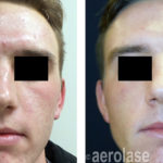 NeoClear Acne – After 3 Treatments – Kevin Pinski MD