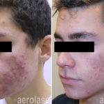 NeoClear Acne – After 4 Treatments – Kevin Pinski MD