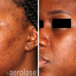 NeoClear Acne – After 4 Treatments – Michelle Henry MD
