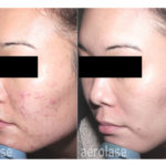 NeoClear Acne – After 6 Treatments – Spade Skin Care