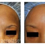 NeoSkin Melasma – After 1 Treatment combined with Glycolic Peel – Cheryl Burgess MD
