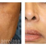 NeoSkin Melasma – After 1 Treatment combined with Hydroquinone – Cheryl Burgess MD