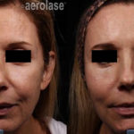 NeoSkin Rejuvenation – After 2 Treatments combined with threads and filler – One Aesthetics